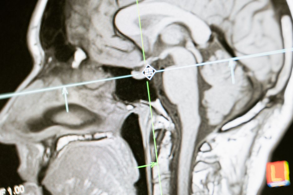 Dépression en 2026 : quatre résultats de recherche et leurs limites Close-up of an MRI scan showing a sagittal view of the human brain for analysis.